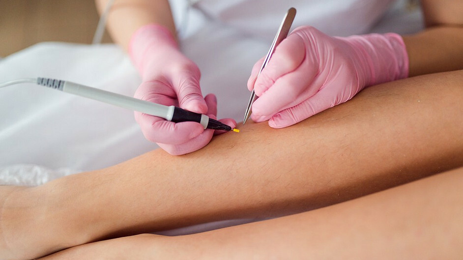 Электро эпиляция